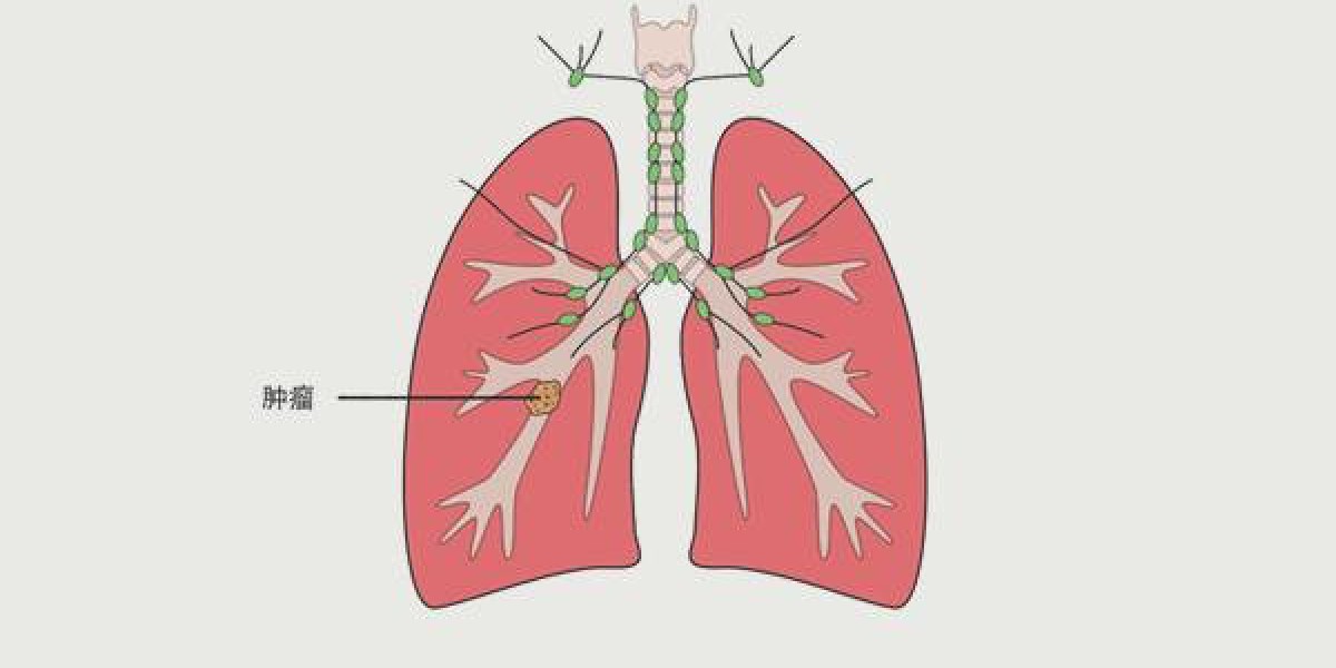 提醒：肺癌开始形成时，通常会感觉这3处不对劲，但很少有人重视